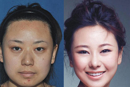 Wanita Ini Lolos Imigrasi Saat Pulang Operasi Plastik di Korea